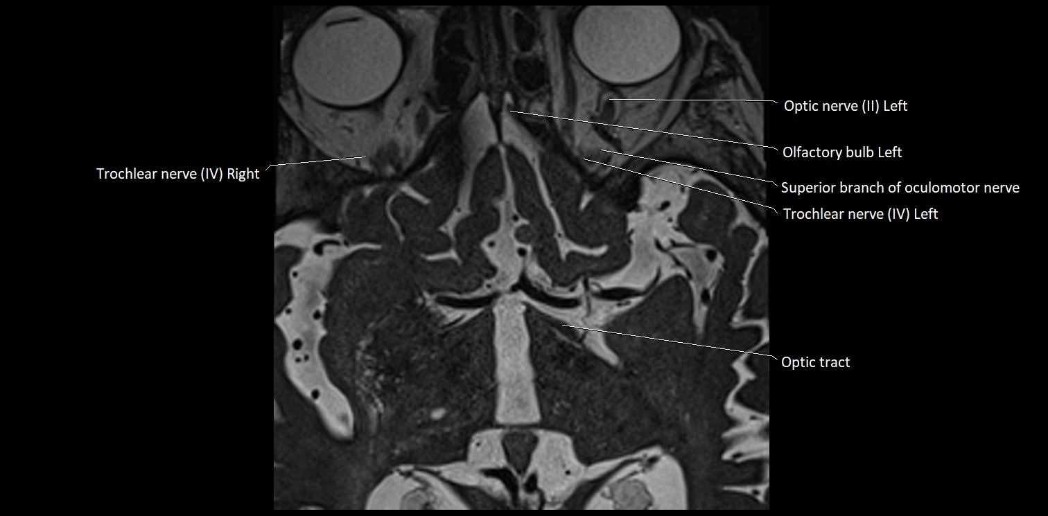 Cranial nerve anatomy axial MRI 3T image 4.webp